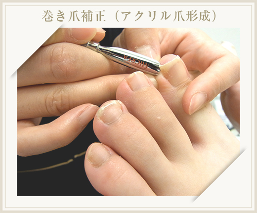 巻き爪 ネイルケアコース プロ養成コース 一般社団法人日本フットケア フスフレーゲスクール